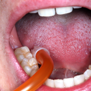 en uso dental blanco – BOMBAS DE SALIVA CON BOQUILLA EXTRAÍBLE 15 CM